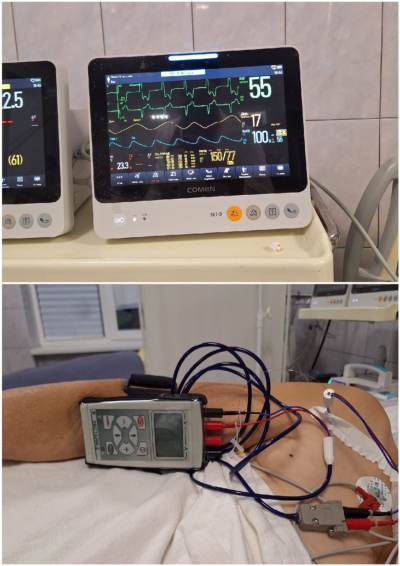 Операция по установке временного электрокардиостимулятора (ЭКС)